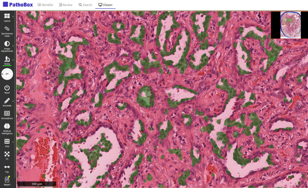Epithelial segmentation algorithm on PathoBox, a digital pathology solution