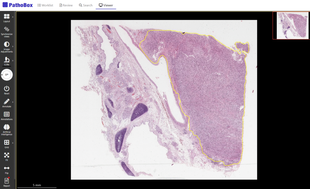 Adenocarcinoma segmentation algorithm in PathoBox Enterprise Digital Pathology macroscopic visualization