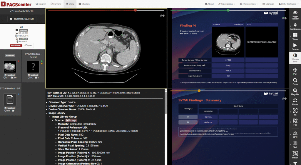 Screenshot of the PACScenter web-native platform by BMD Software featuring the SYCAI AI integration. The interface displays an abdominal CT scan alongside automated lesion detection results, volumetric data, and a SYCAI Findings Summary table for clinical assessment.